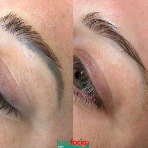 بهترین خدمات تتو ریمووال در تهران | مرکز ریموو تاتو در تهران