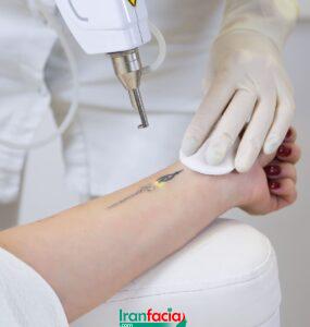 بهترین خدمات تتو ریمووال در جنوب تهران | مرکز ریموو تاتو در جنوب تهران